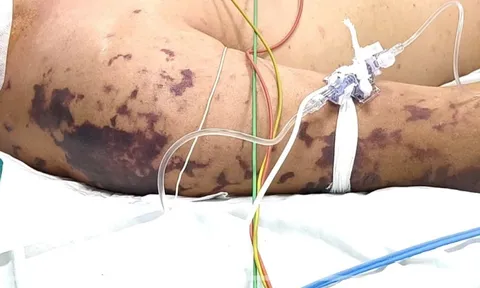 Ăn thịt lợn ở đám cỗ, người đàn ông 52 tuổi lơ mơ, nguy kịch