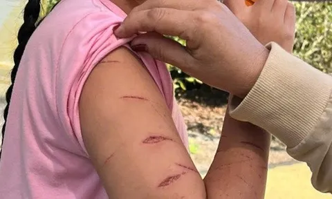 Nữ sinh lớp 5 ở Cà Mau bị người thân dùng dao cắt giấy gây thương tích