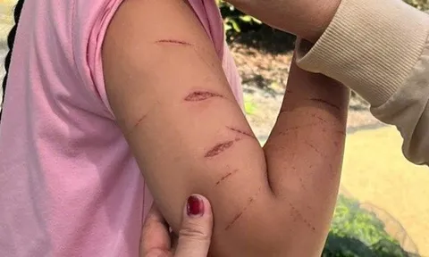 Chủ tịch UBND tỉnh Cà Màu chỉ đạo khẩn vụ nữ sinh lớp 5 bị gây thương tích