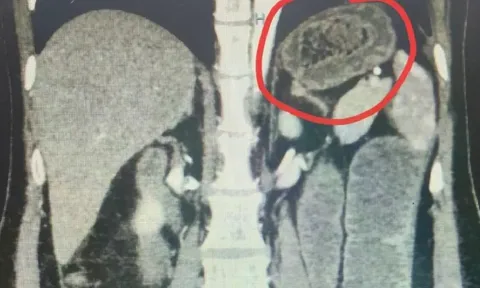 Người phụ nữ bụng "cứng như đá", bác sĩ sốc khi phát hiện bí mật "đáng sợ"