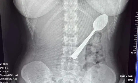 Đang ăn sữa chua, người phụ nữ nuốt chiếc thìa dài 17cm vào bụng