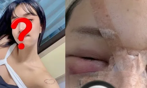 Trùng tu nhan sắc để ăn Tết, 1 sao nữ mặt mũi biến dạng, sưng phồng như bị "500 con ong đốt"