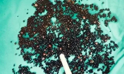 5000 viên sỏi lấp kín túi mật người đàn ông: Bác sĩ nói thẳng: "3 thói quen này là nguyên nhân"