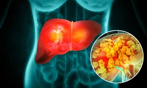 Không phải thịt mỡ, đây mới là "kẻ thù" số 1 của gan: Hóa ra là thứ vạn người mê mẩn