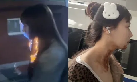 Nữ diễn viên bị bỏng nặng gương mặt ngay trong ngày sinh nhật tuổi 27 vì đu trend "bánh kem phun lửa"