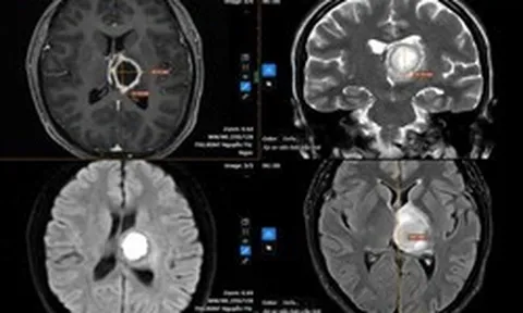 Thường xuyên buồn ngủ, đi khám “sốc” nặng khi biết nguyên nhân