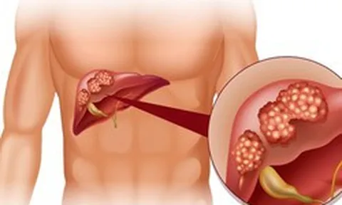 Cảnh báo từ WHO: 1 loại ĐỘC TỐ gây ung thư ẩn trong nhiều thực phẩm quen thuộc mà người Việt ĂN MỖI NGÀY