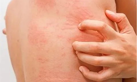 Thấy vàng da kèm ngứa, người phụ nữ đi khám phát hiện mắc 2 loại ung thư: Bệnh viện Bạch Mai nói quá hiếm gặp, thách thức trong chẩn đoán