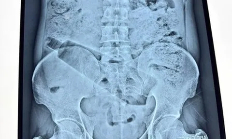 Người đàn ông đau bụng 36 tiếng, bác sĩ phát hiện "bí mật" bên trong