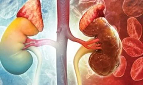Suy thận có thể tấn công bất ngờ không báo trước: Đây là 4 đối tượng cần đặc biệt cảnh giác