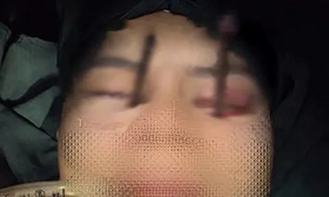 Chàng trai 25 tuổi đau mắt dữ dội, bác sĩ phát hiện bí mật "đáng sợ"