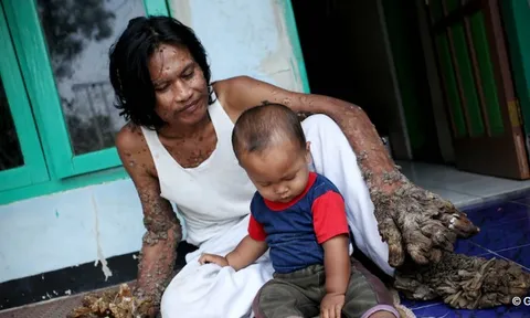 Bí ẩn dị nhân biến thành “quái vật rừng” vì căn bệnh lạ kéo dài gần 3 thập kỷ