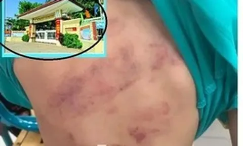 Học sinh lớp 1 bị bạn đánh hội đồng, phụ huynh bức xúc vì con phải chuyển lớp