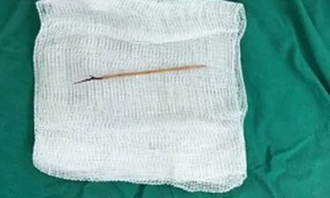 Bác sĩ sốc khi phát hiện chiếc tăm tre cắm trong tim bé trai 13 tuổi