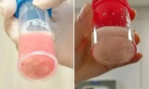 Cô bé 12 tuổi phổi trắng xóa và đông đặc sau 1 ngày bị sốt, bác sĩ cảnh báo: Đừng lúc nào cũng tưởng con cảm lạnh!