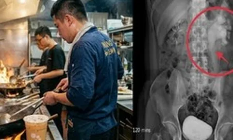 Nam đầu bếp 32 tuổi phù thận cấp tính vì 1 thói quen uống nước không ít người vẫn làm mỗi ngày
