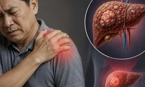 Cảnh báo 1 TÍN HIỆU cực quan trọng của ung thư gan: Nhiều người còn cố cãi chỉ đau vai thông thường