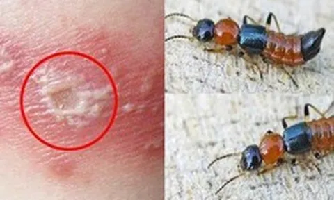 5 bước xử lý đúng cách khi tiếp xúc với kiến 3 khoang